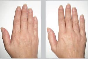Hand Rejuvenation