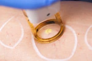 Laser Spider Vein Treatment