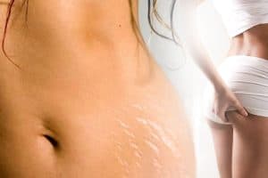 Stretch Mark Treatment