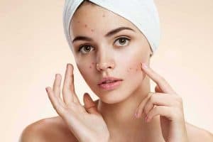 Acne Treatment