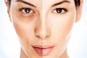 Pigmentation Treatment