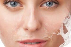 Chemical Peel