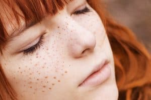 What Are Freckles?