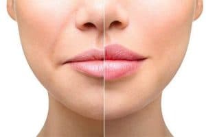 Types of Lip Filler