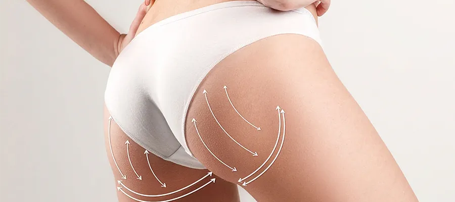 BBL (Brazilian Butt Lift)