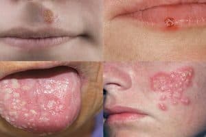 Cold Sores (Herpes)