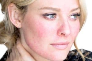 What Is Rosacea?