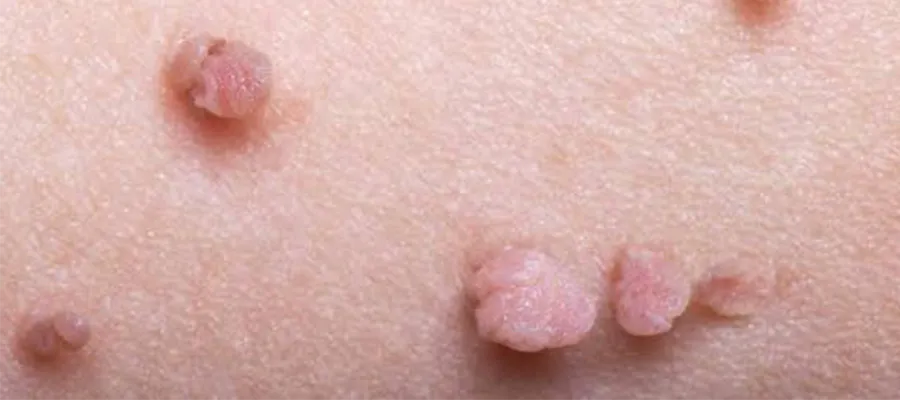 Genital Wart Treatment