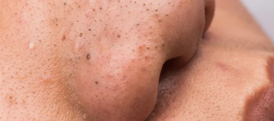 Blackheads