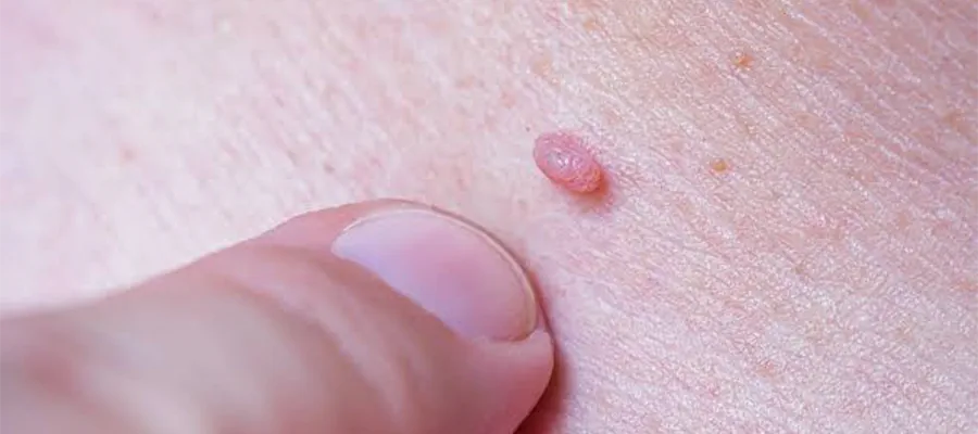 HPV
