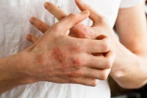 Eczema (Contact Dermatitis)