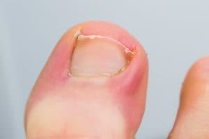 Ingrown Nail Treatment