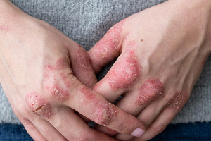 Psoriasis