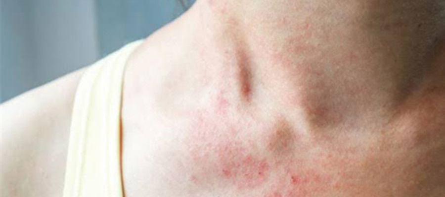 Scabies Treatment