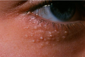 Syringoma