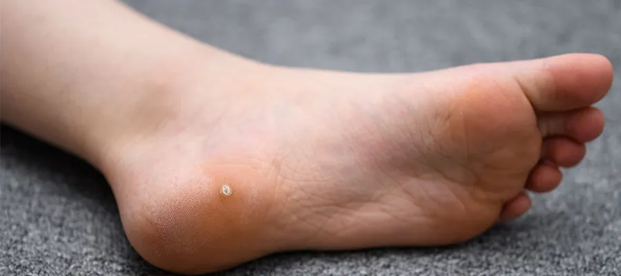 Hand and Foot Wart Treatment