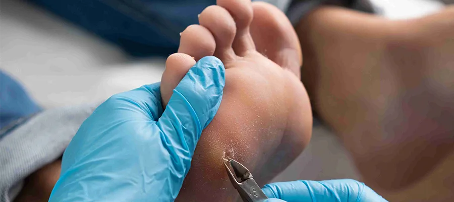 Corn (Callus) Treatment